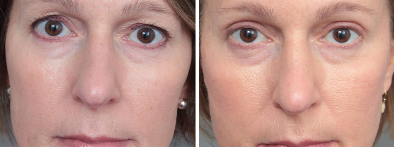 The Benefits of Eyelid Surgery Beyond Aesthetic Improvements