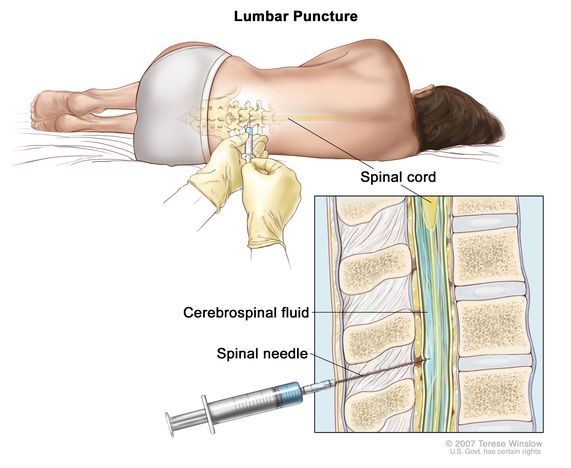 Lumbar Puncture