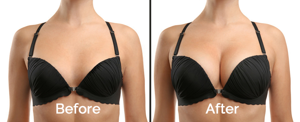 Breast Enhancement Cost in Dubai: What to Expect