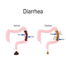 diarrhoea