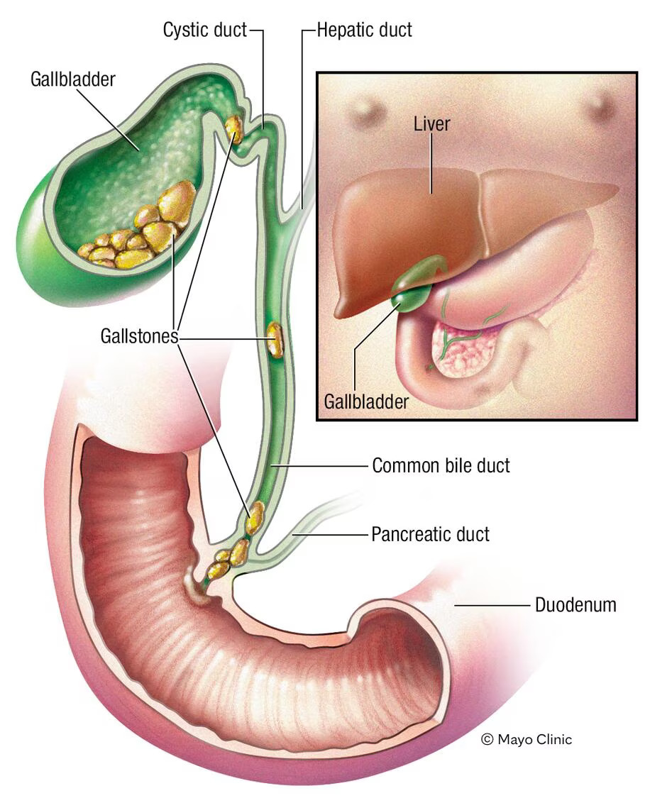 gallstones