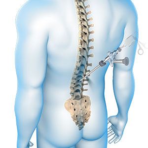 spinal tumor surgery