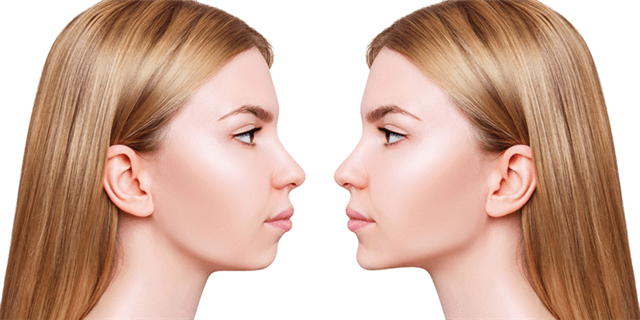 The Importance of Choosing the Best Dermal Fillers Dermatologists in Dubai