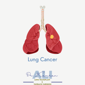 Best Doctor for Lung Cancer in Delhi: Dr. Kamran Ali.