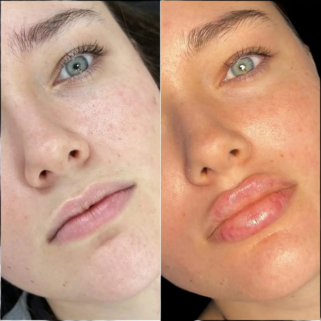 Juvederm Fillers