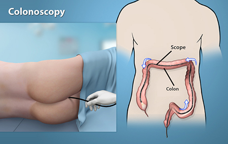 COLONOSCOPY