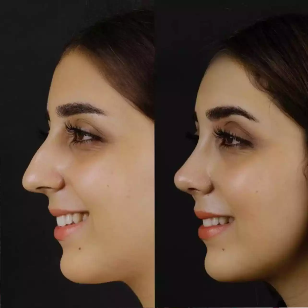 Your Path to a Perfect Profile: Nose Surgery in Dubai