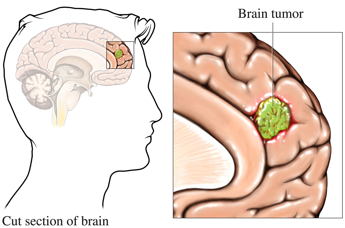 brain tumor