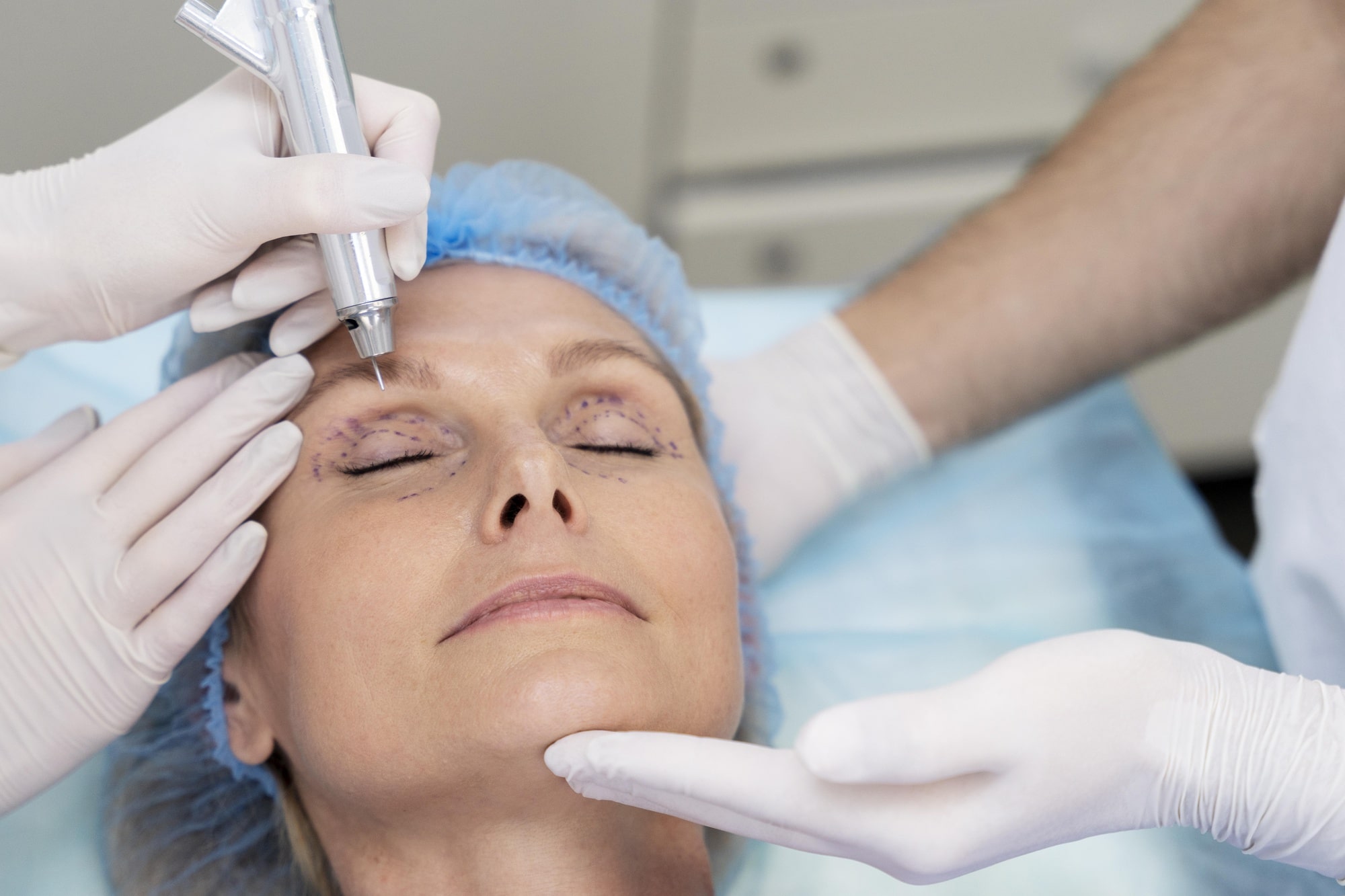 laser treatment for wrinkles