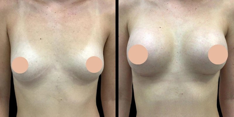 Understanding the Different Breast Augmentation Techniques Available in Dubai